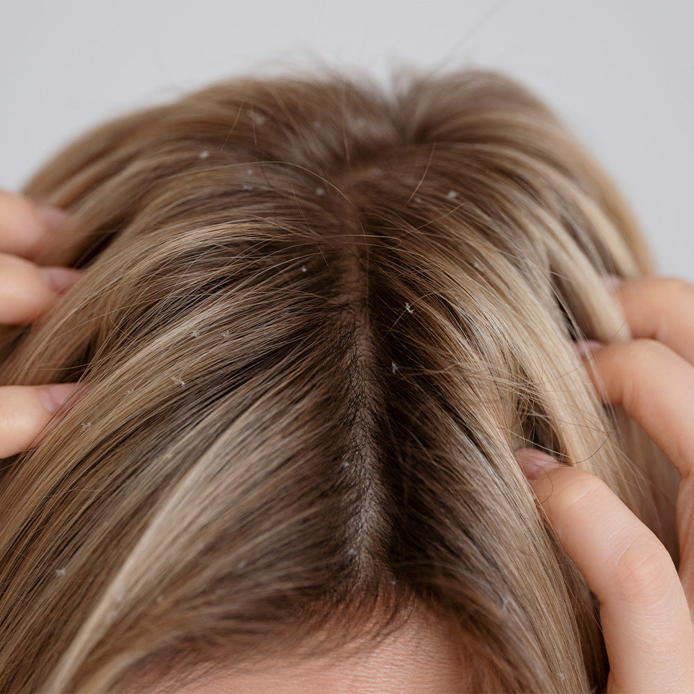 Oily dandruff, itchy scalp